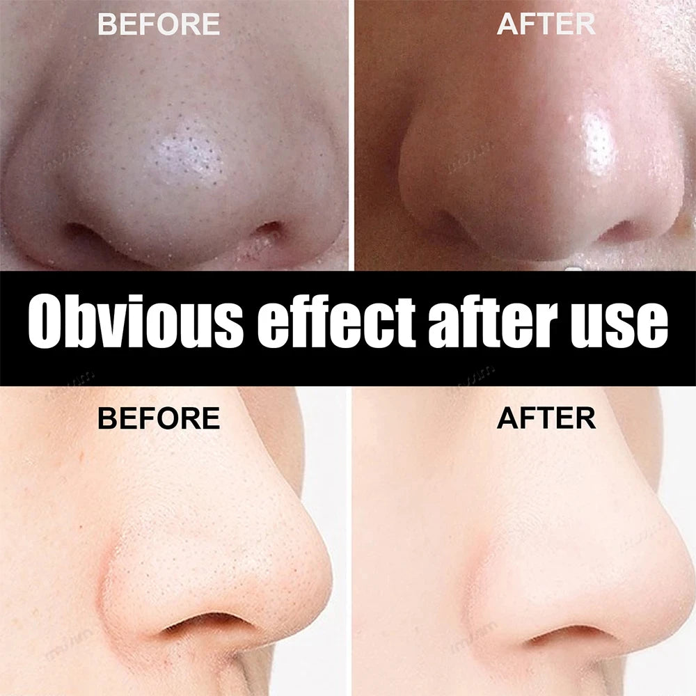 Bamboo Charcoal Nasal Strips Blackhead Remover Mask